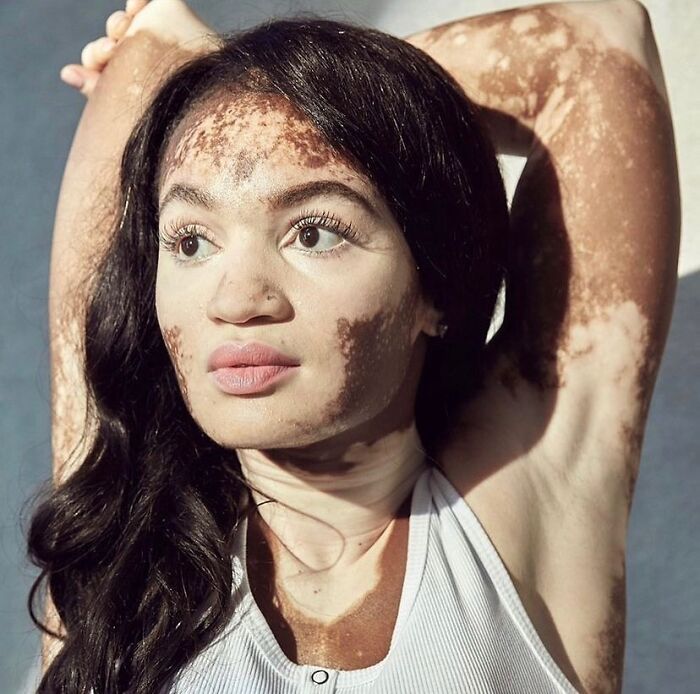 These People With Vitiligo Are Turning Their Skin Into Living Art (35 Pics)