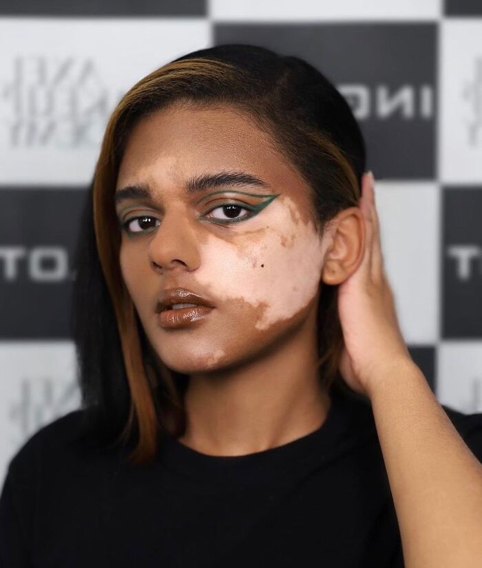 These People With Vitiligo Are Turning Their Skin Into Living Art (35 Pics)