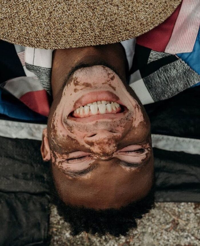 These People With Vitiligo Are Turning Their Skin Into Living Art (35 Pics)
