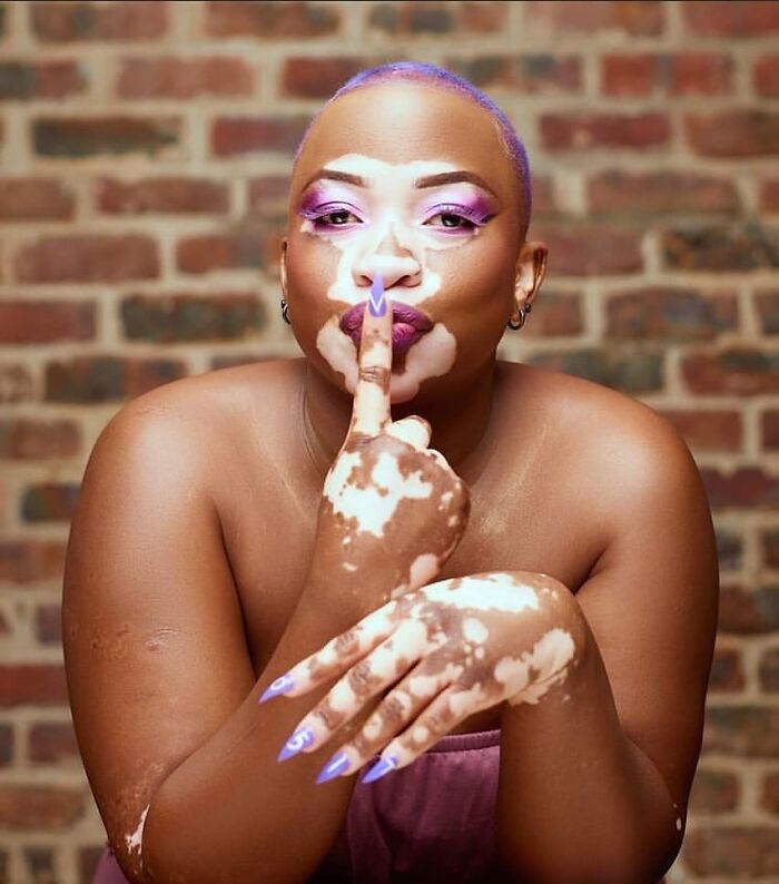 These People With Vitiligo Are Turning Their Skin Into Living Art (35 Pics)