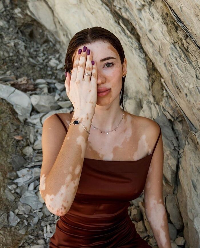 These People With Vitiligo Are Turning Their Skin Into Living Art (35 Pics)