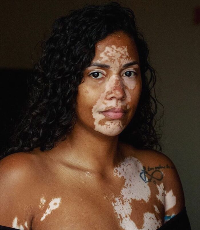 These People With Vitiligo Are Turning Their Skin Into Living Art (35 Pics)