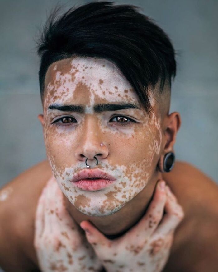 These People With Vitiligo Are Turning Their Skin Into Living Art (35 Pics)