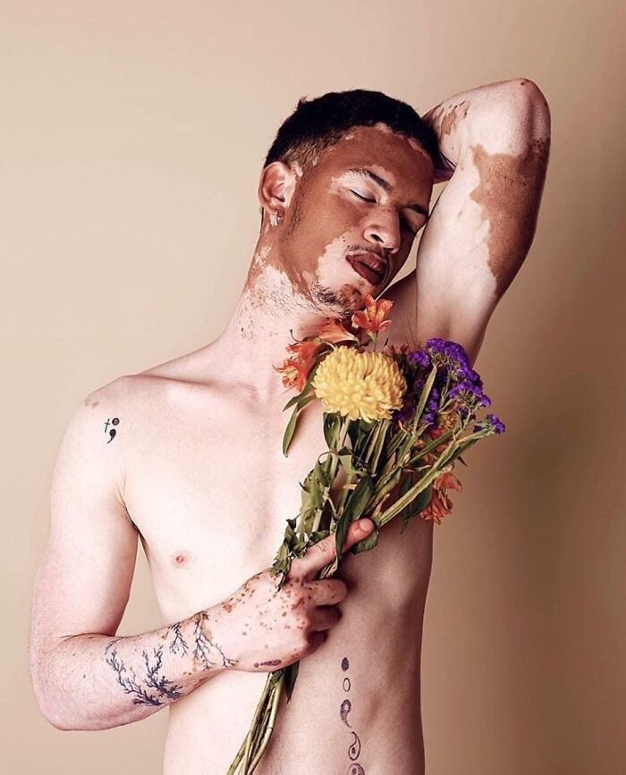 These People With Vitiligo Are Turning Their Skin Into Living Art (35 Pics)