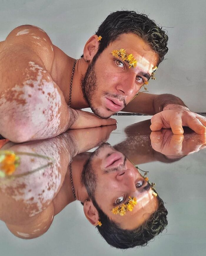 These People With Vitiligo Are Turning Their Skin Into Living Art (35 Pics)