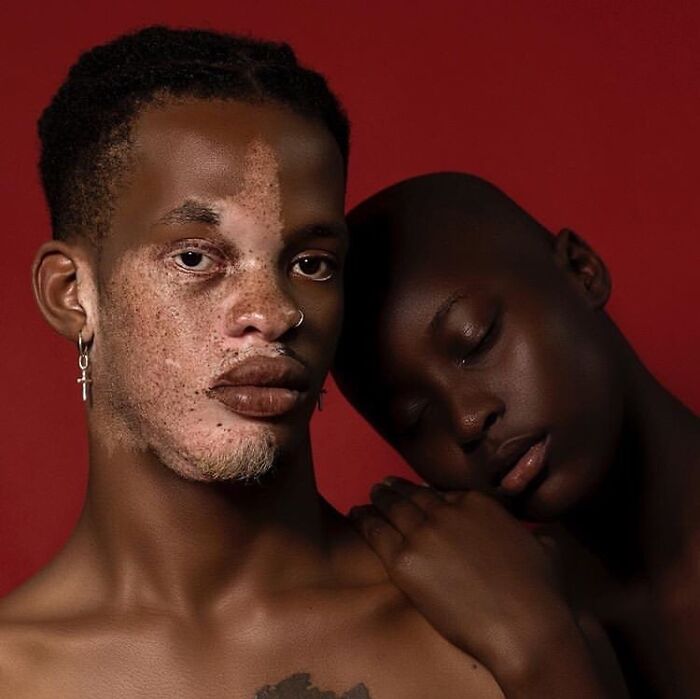 These People With Vitiligo Are Turning Their Skin Into Living Art (35 Pics)