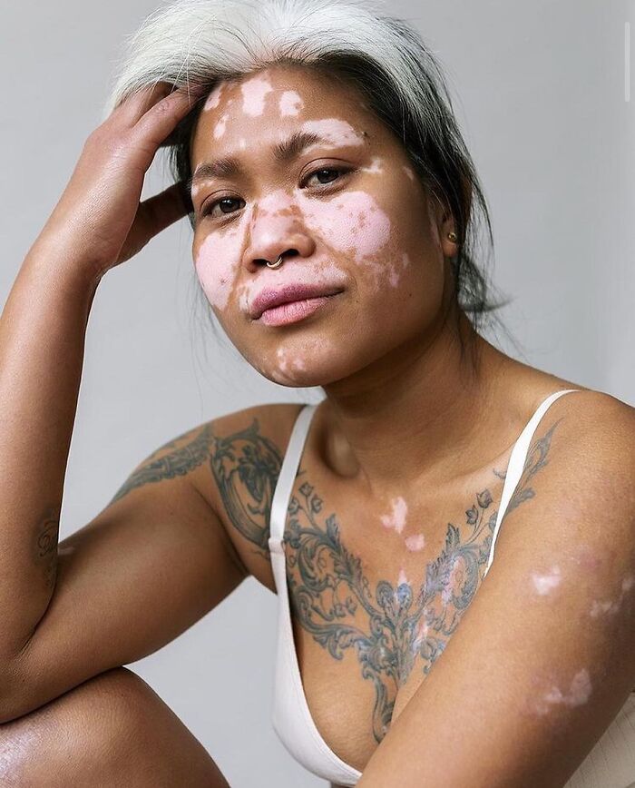These People With Vitiligo Are Turning Their Skin Into Living Art (35 Pics)