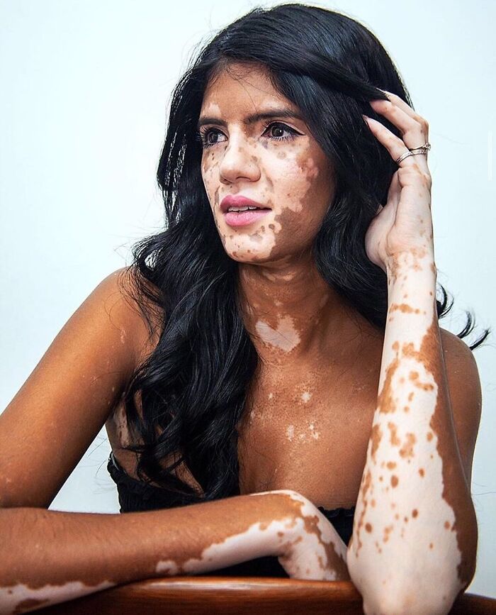 These People With Vitiligo Are Turning Their Skin Into Living Art (35 Pics)