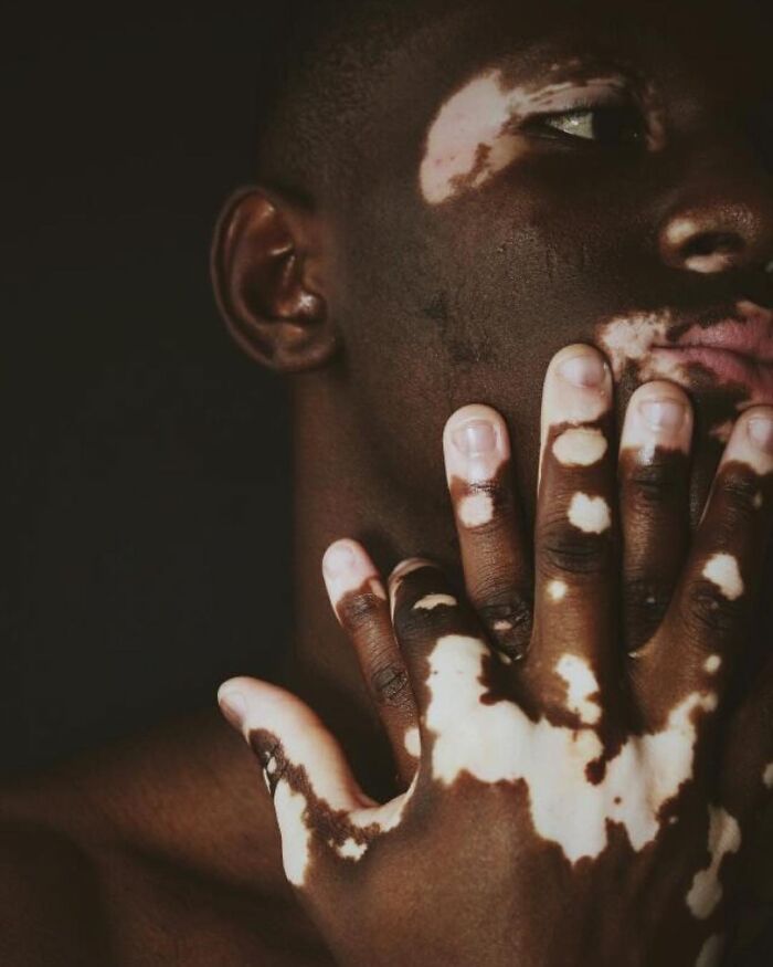 These People With Vitiligo Are Turning Their Skin Into Living Art (35 Pics)