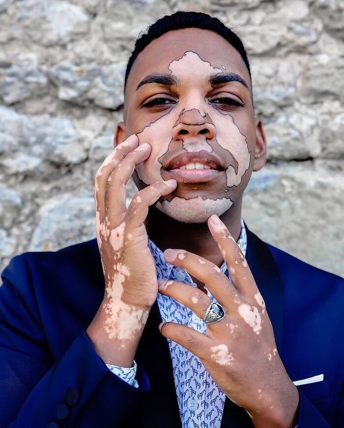 These People With Vitiligo Are Turning Their Skin Into Living Art (35 Pics)