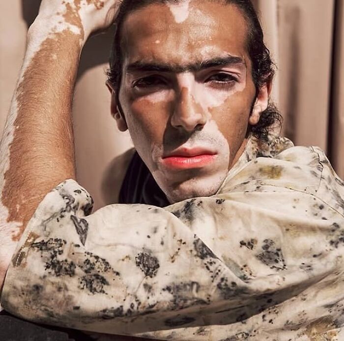 These People With Vitiligo Are Turning Their Skin Into Living Art (35 Pics)