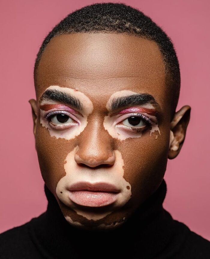 These People With Vitiligo Are Turning Their Skin Into Living Art (35 Pics)