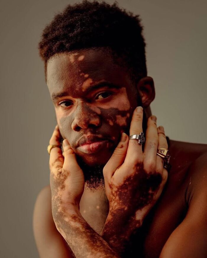 These People With Vitiligo Are Turning Their Skin Into Living Art (35 Pics)