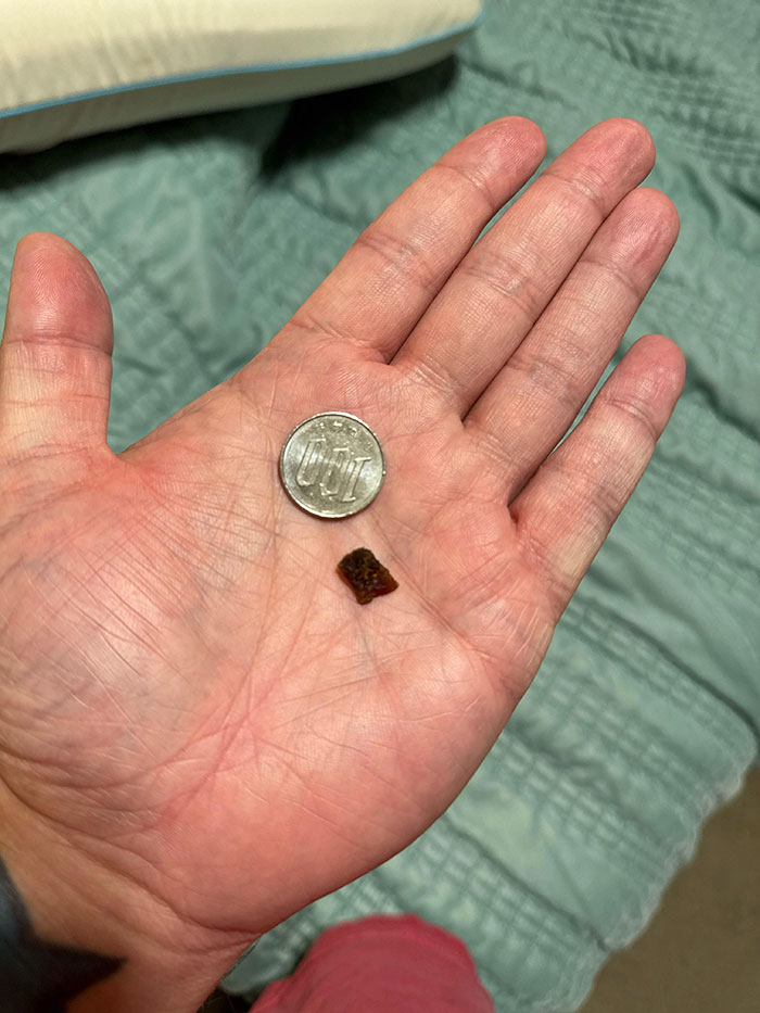 Hand holding a small dark object and a coin, illustrating a throat pain medical mystery solved after 35 years.
