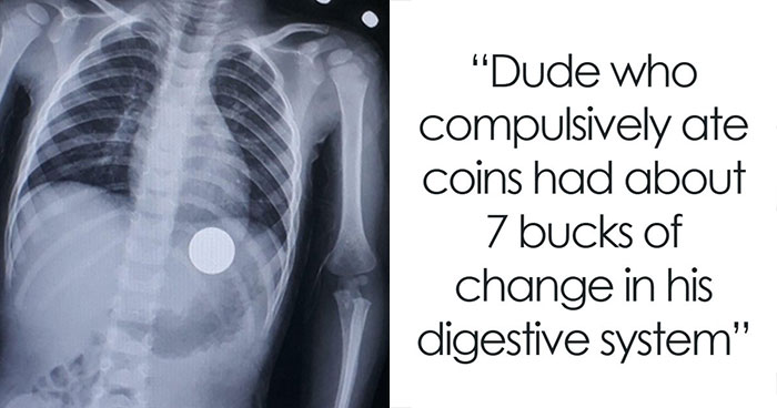 44 Autopsy Doctors Share The Most Bizarre Cases They’ve Ever Seen