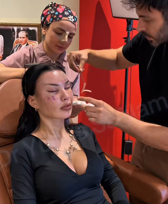 Woman undergoing cosmetic procedure with medical staff applying treatment in a clinic setting featuring before-and-after markings.