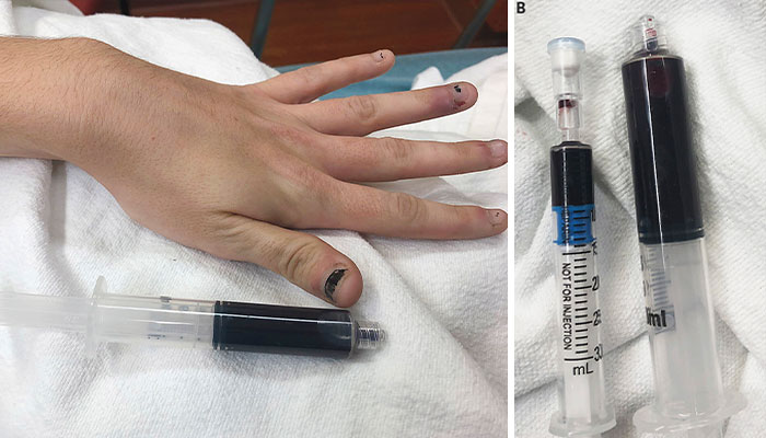 Close-up of a hand with darkened fingernails next to syringes filled with dark blood, illustrating bizarre medical problems.