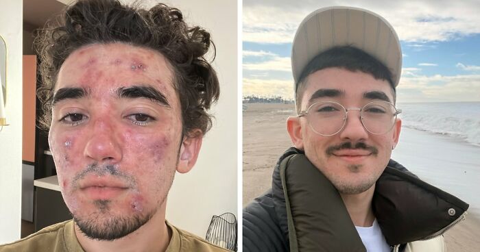 Before and after images showing an incredible transformation of a young man’s skin and confidence over three years.