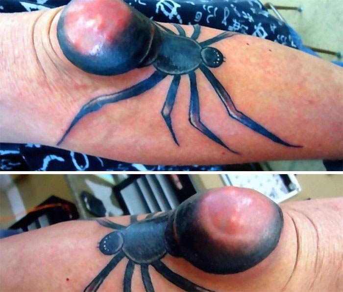 Tattoo ink fail showing a distorted spider design on an arm, illustrating permanent tattoo regrets.