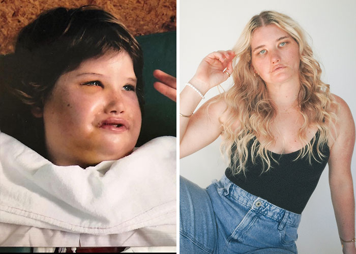 Young boy and young woman, both showing signs of bizarre medical problems and mysteries that gained media attention.