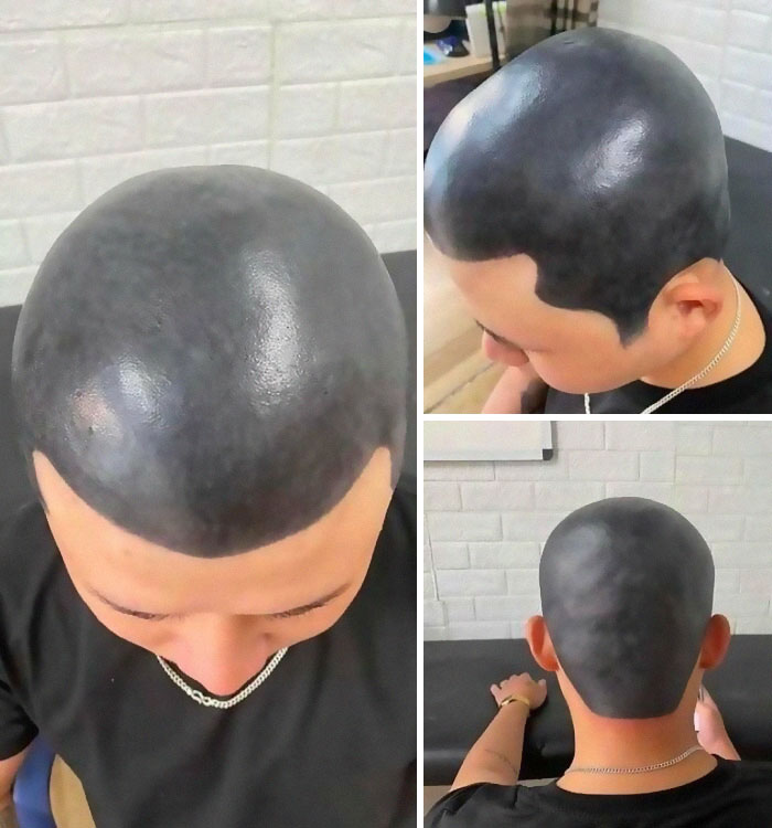 Man with a scalp tattoo that looks like a poorly done hairline causing an ink fail and permanent regret.