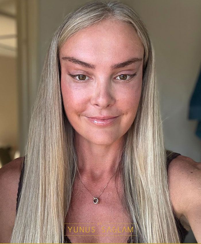Woman with long blonde hair showing results of cosmetic procedure in natural indoor light, highlighting before and after transformation