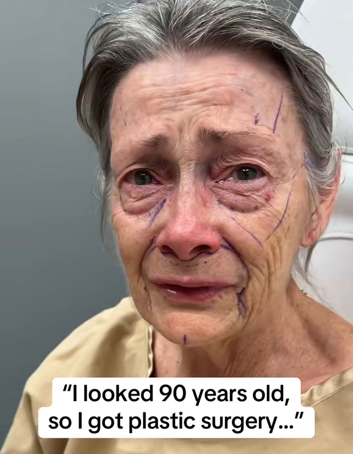 Elderly woman with surgical markings on face before transformation by miracle plastic surgeon.
