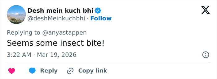 Tweet by user Desh mein kuch bhi replying to Anya Taylor-Joy, commenting on an insect bite spotted in the interview appearance.