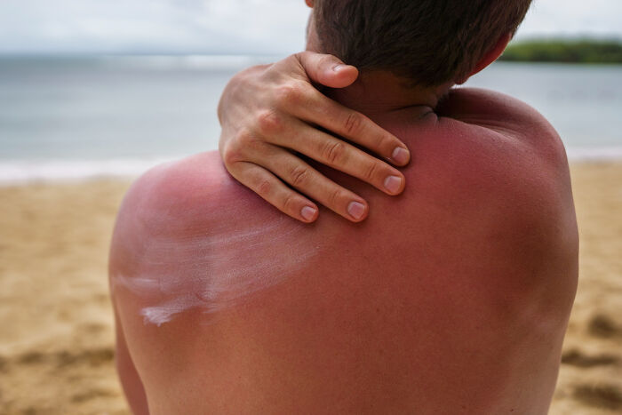 Person with sunburn applying sunscreen on back at the beach, illustrating cultural things people thought were normal abroad.