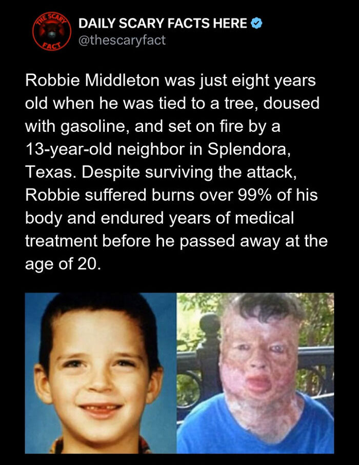 Before and after photos of Robbie Middleton, illustrating a scary fact about severe burns and survival challenges.
