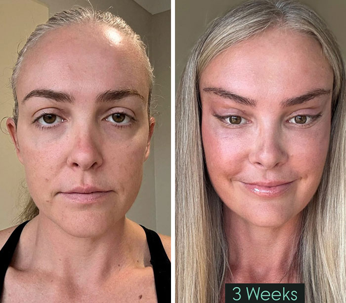 Before-and-after cosmetic procedure comparison showing a woman's facial transformation after three weeks.
