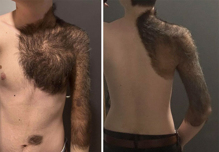 Close-up front and back views of a man with patchy, uneven hair growth covering his left shoulder, arm, and upper chest unusual image