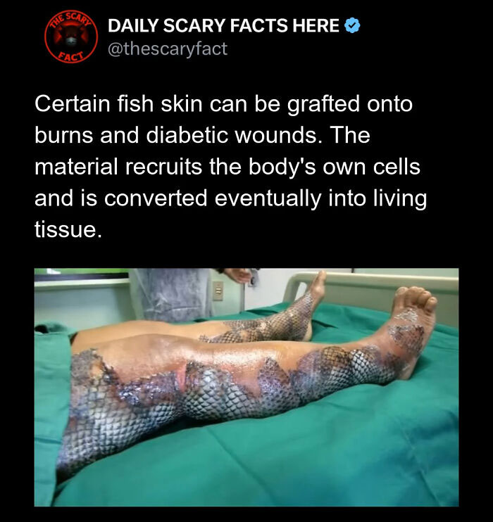 Legs with fish skin grafts on burns and diabetic wounds, showing the use of regenerative tissue in medical treatment.