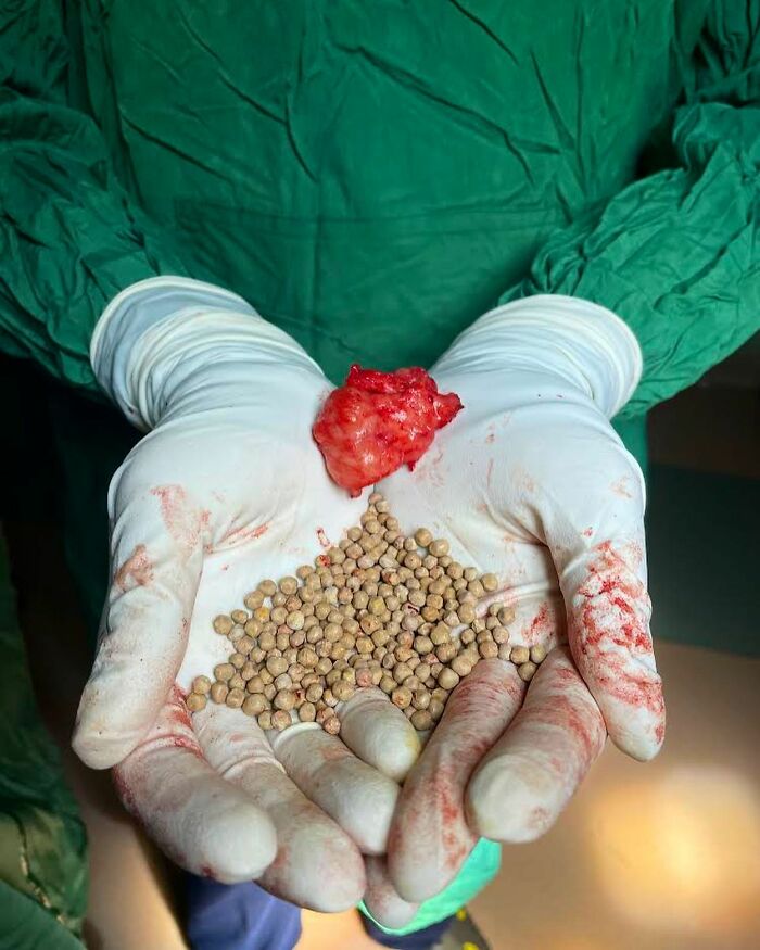 Surgical gloves holding unusual medical photo of removed tissue and numerous small spherical objects covered in blood.