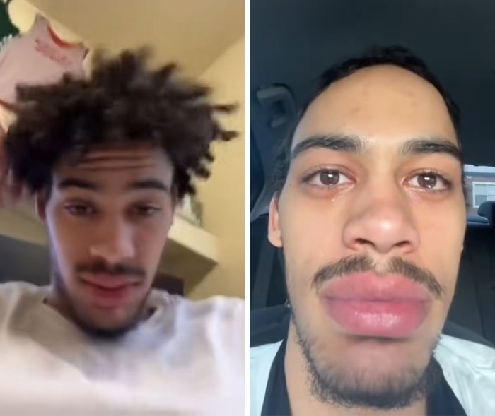 Man with messy hair before haircut and swollen lips after a hairdresser's unexpected result causing shock and trauma.