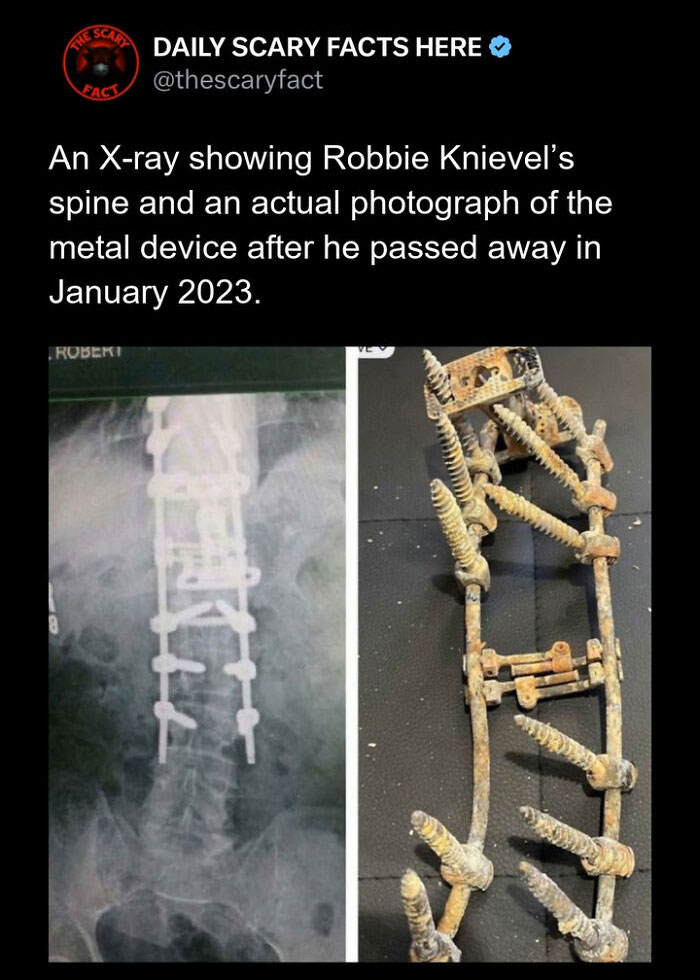 X-ray and photo of Robbie Knievel’s spine with metal device, a scary fact about surgical implants and bone support.