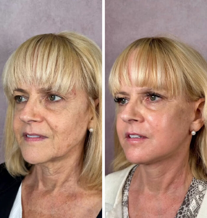 Before and after images of a grandma showing a miracle plastic surgeon's transformation to look decades younger.