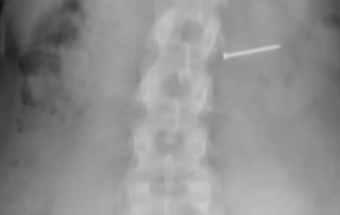 Mulher ganha US$ 14 milhões depois que sorvete a deixou incapaz de ter filhos