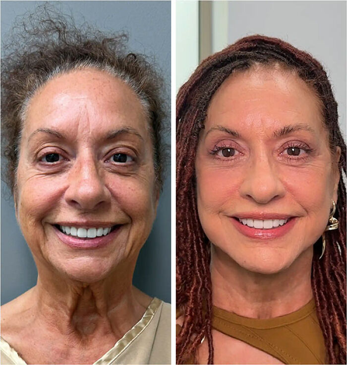 Before and after photos showing a grandma&rsquo;s transformation by a miracle plastic surgeon to look decades younger.