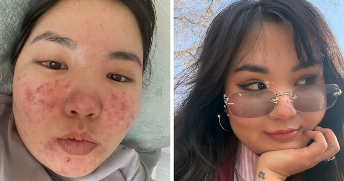 Before and after photos showing a woman's unbelievable transformation with clear skin and confidence in three years.