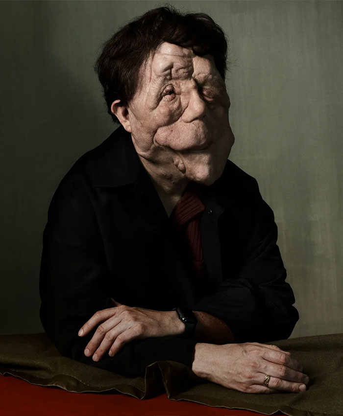 Pessoa com diferença facial sentada com os braços cruzados, destacando Adam Pearson e fãs gritando tweet ofensivo do comediante.