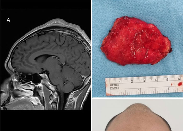 MRI scan showing a brain tumor, surgical removal of a large mass, and a close-up of a bald human head with a scalp abnormality.