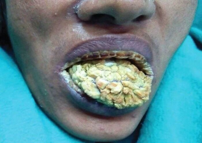 Close-up of a person's mouth showing an extreme case of green hairy tongue with thickened, discolored tongue coating.