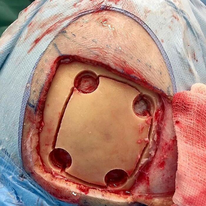 Close-up of an unusual medical photos showing a surgical bone reconstruction procedure with circular cuts and exposed tissue.
