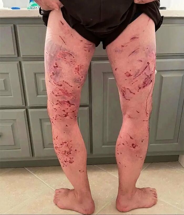 Lower legs with severe bruises and cuts, showcasing unusual medical injuries that land between science and nightmare.