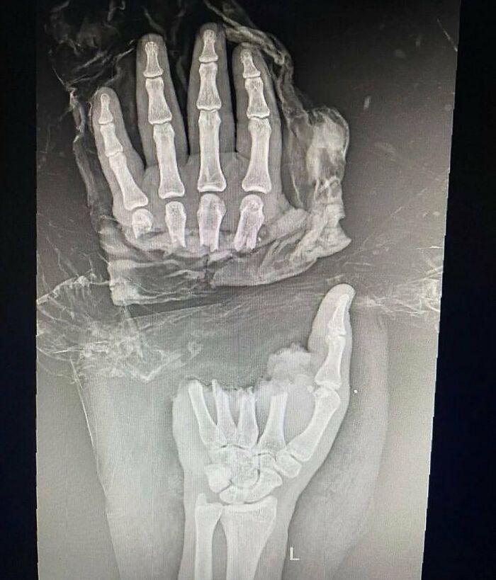 X-ray showing unusual medical condition with overlapping hand bones, illustrating strange anatomy for medical photos.