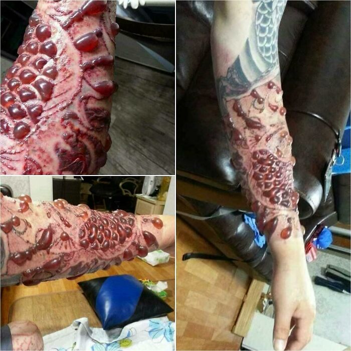 Close-up of a forearm with unusual medical photos showing abnormal skin texture resembling severe blisters and lesions.