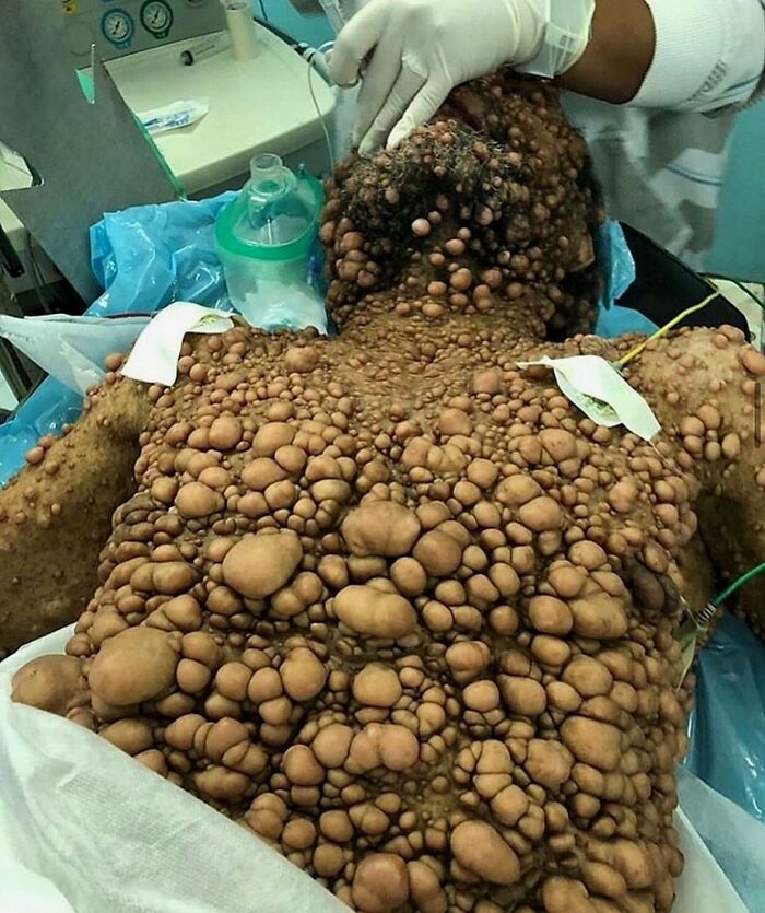 Patient covered in large and small nodules all over skin, a rare medical condition requiring caution and expert care.