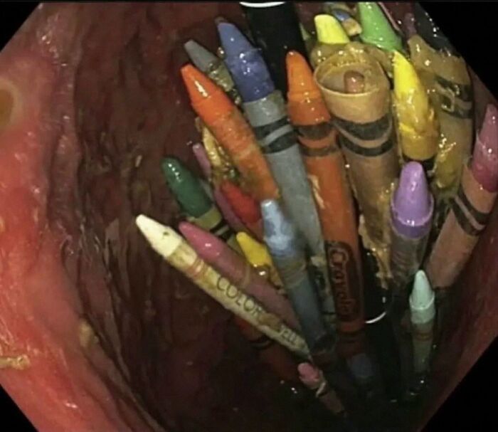 Close-up medical image showing green hairy tongue resembling colorful crayons inside the mouth cavity.