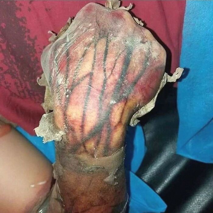 Close-up of a medical condition showing a discolored, hairy tongue with unusual texture and dark veins.